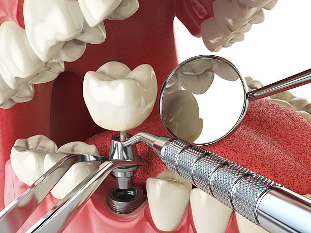 Best Emergency Dental Care for Broken or Chipped Teeth in Pearl, MS